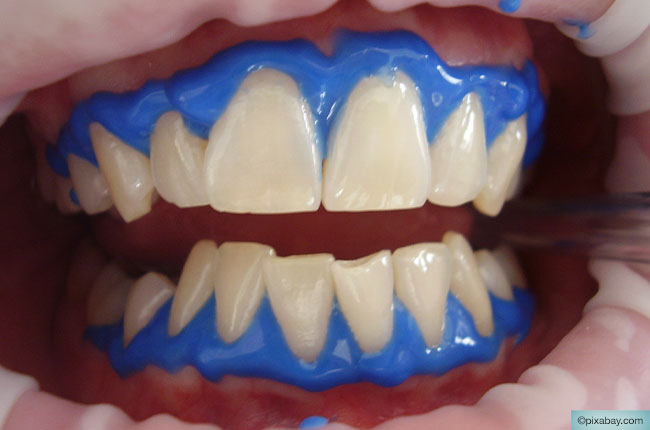 Schöne Zähne mittels Zahnreinigung und Bleaching